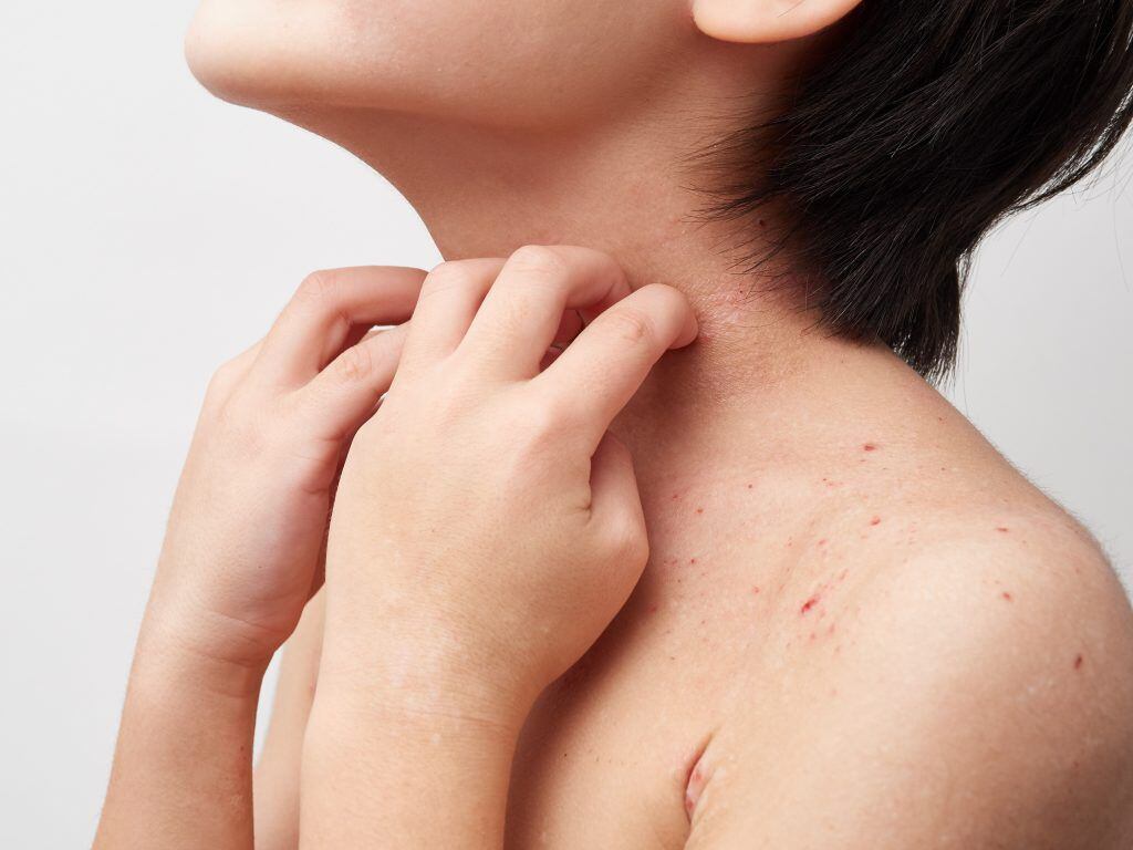 Pacientes con Dermatitis Atópica pueden tener comprometida su salud con brotes intensos hasta 6 meses en el año