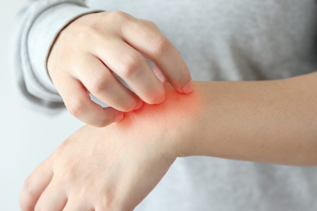 Pacientes con Dermatitis Atópica pueden tener comprometida su salud con brotes intensos hasta 6 meses en el año
